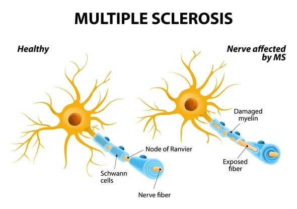 Multiple Sclerosis shutterstock 239380201 |